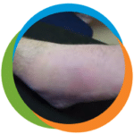 ankle-gout-1